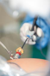 Minimally invasive laparoscopic surgery allows surgeons to perform many common colon procedures through small incisions.
