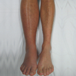 Deep Vein Thrombosis affected Legs. DVT Awareness Month