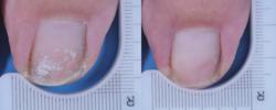 Before and After Images of Laser Treatment for Toenail Fungus