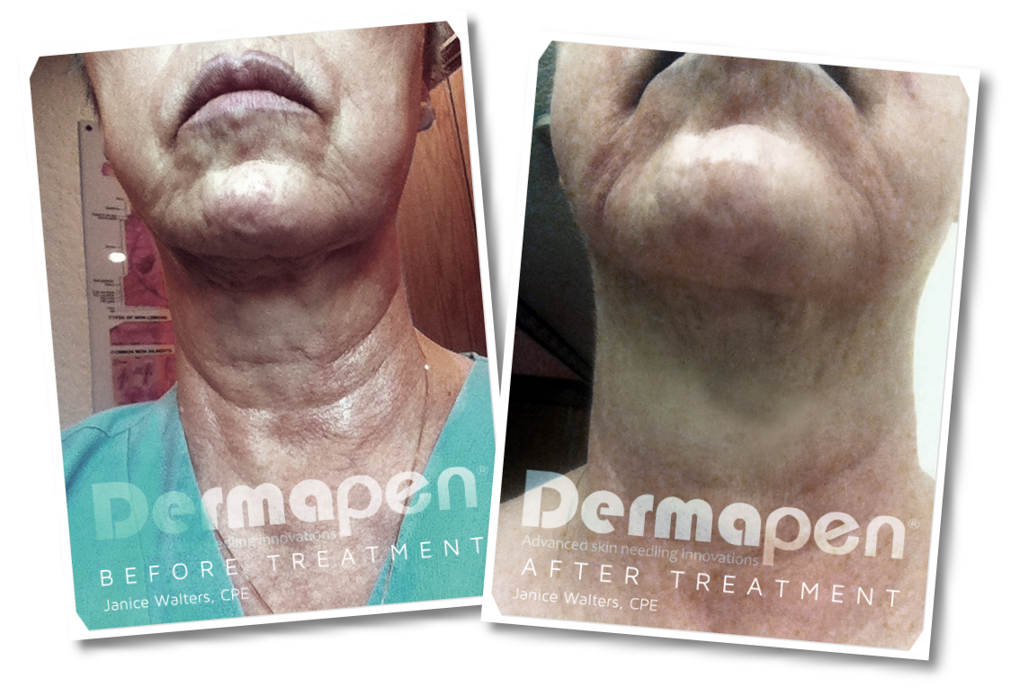Before and After Micro Needling  with Dermapen®