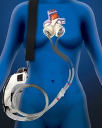 Record Number of Total Artificial Heart Abstracts to be Presented by 20 ...