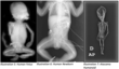 Human Fetus & Newborn compared to Atacama Humanoid X-rays