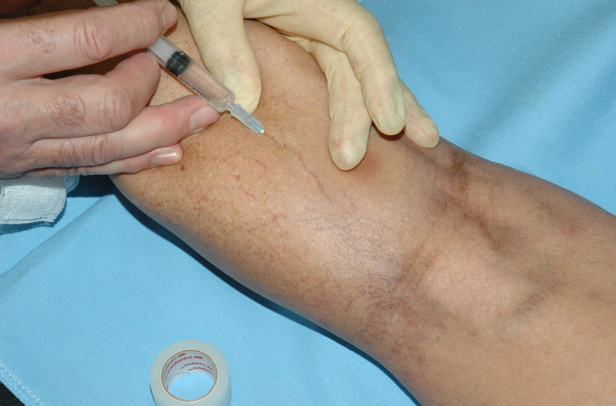 Sclerotherapy is effective, fast, virtually painless.