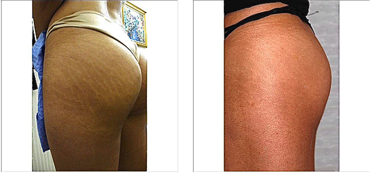 Stretch Marks Before and After
