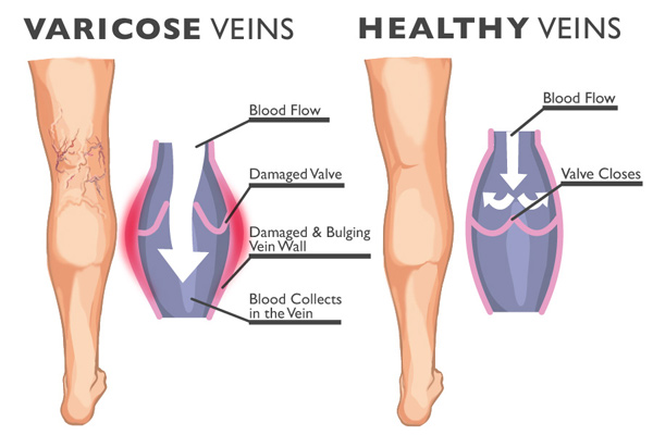 Varicosities are the enlarged bulging veins, caused by veins working improperly.