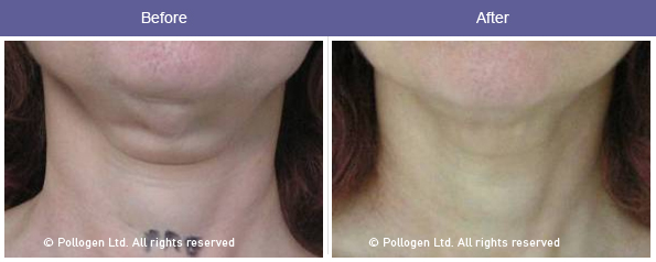 TriPollar skin tightening results