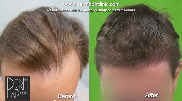 Close up view of patient's hairline and temples