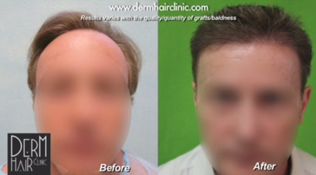 Patient before and after his hairline and temple point reconstruction with uGraft