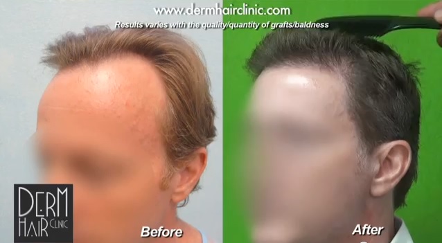Patient's temples are now much less wide. They are also ideally balanced with his hairline