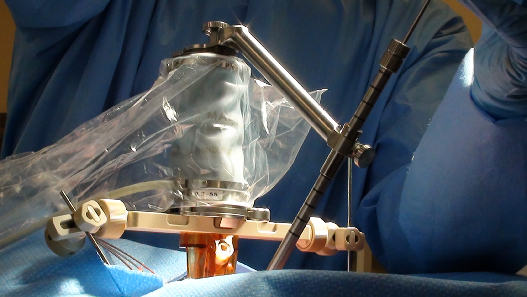 Mazor Renaissance Robot in use during surgery