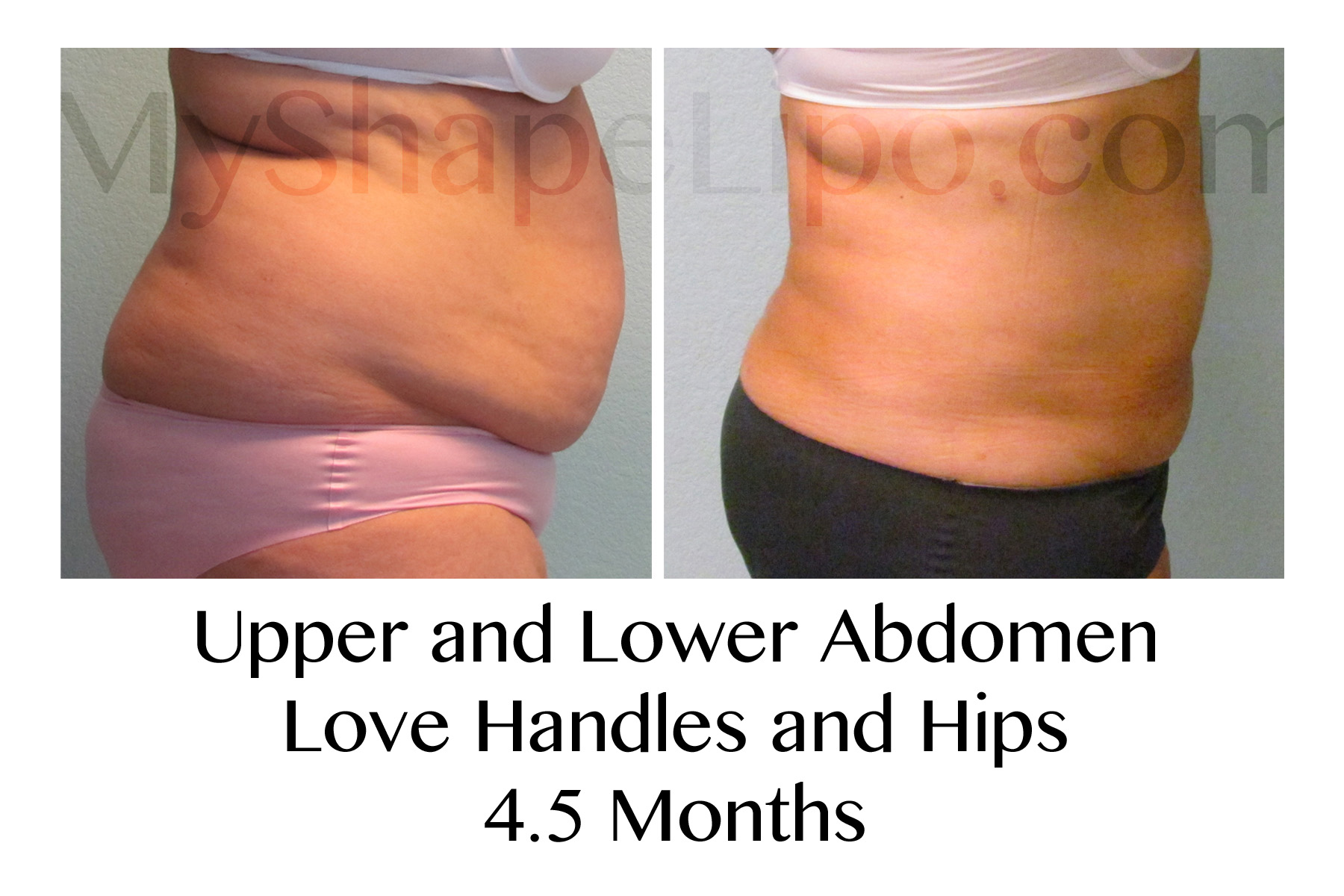 images of a stomach before and after tummy tuck