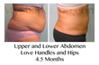 liposuction, smart lipo, liposuction of the abdomen, myshape lipo, trevor schmidt