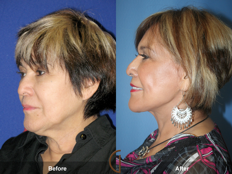 Lower Face and Neck Lift Picture