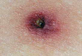 Ticks Will Enflame The Skin If They Attach