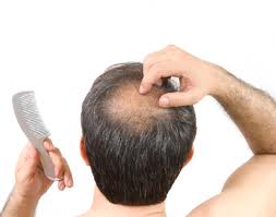 NuBody Concepts Offers Hair Replacement Solutions