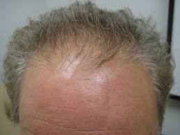 Hair Restoration For Men