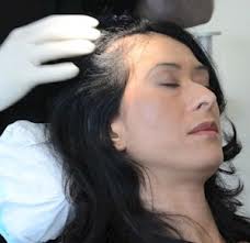Hair Grafts Are Used For Hair Restoration In Men And Women