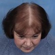 hair loss in a woman