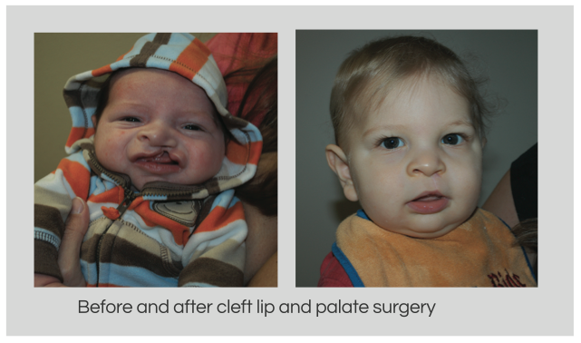 Patient After Cleft Lip Reconstruction