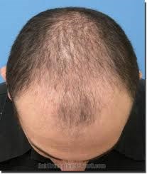 hair loss in a man