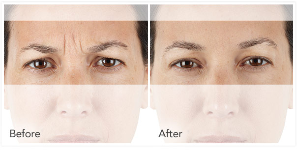 Xeomin before/ after