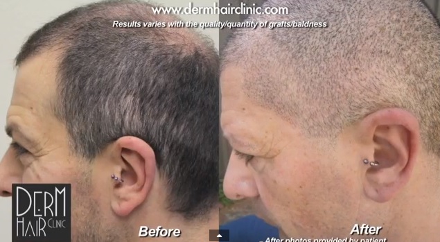 results of body hair transplant