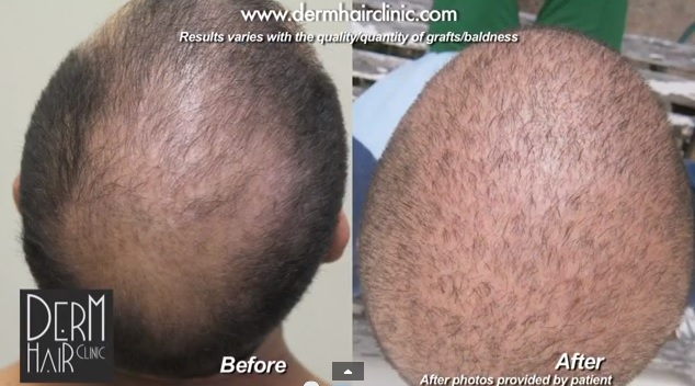 Derm Hair Clinic Unveils New Patient Results of 13,000 Graft Hair Transplant  for Full Coverage and Concealment of Strip Scar
