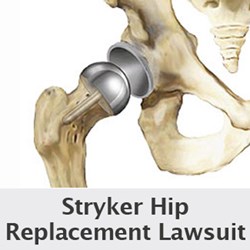 Stryker Hip Lawsuit