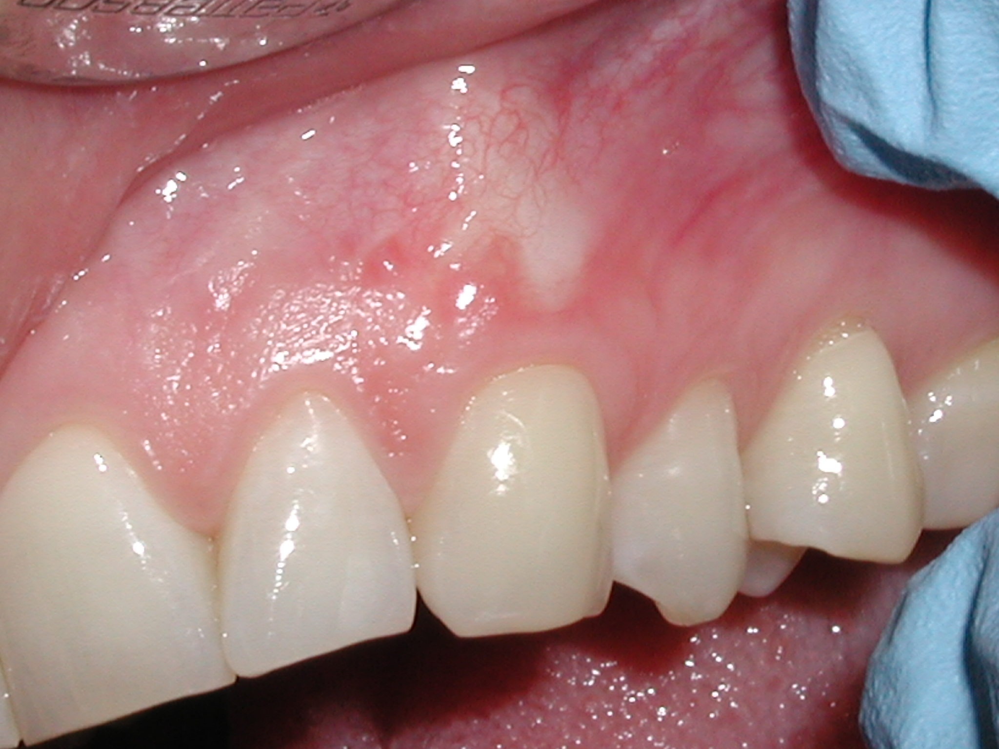 After Soft Tissue Grafting procedure. Dr. Noraian helps restore missing gum line.