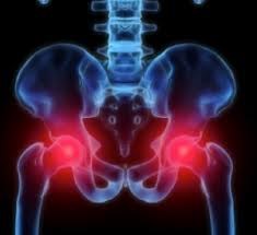 ASR Pinnacle Hip: serious complications