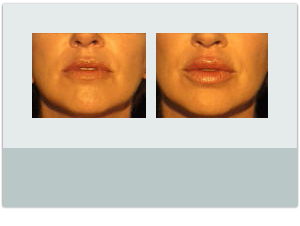Luscious Lips™ Before and After