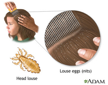 Head Lice Treatment & Removal