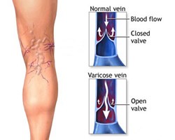The Comprehensive Vein Treatment Center is announcing the launch of a new public health campaign about venous insufficiency.