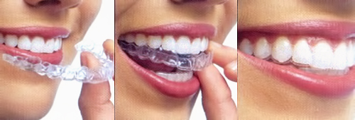 teeth braces straighten without way clear straightening straight aligners smile cosmetic need treatment crooked dentist offering york perfect system cost