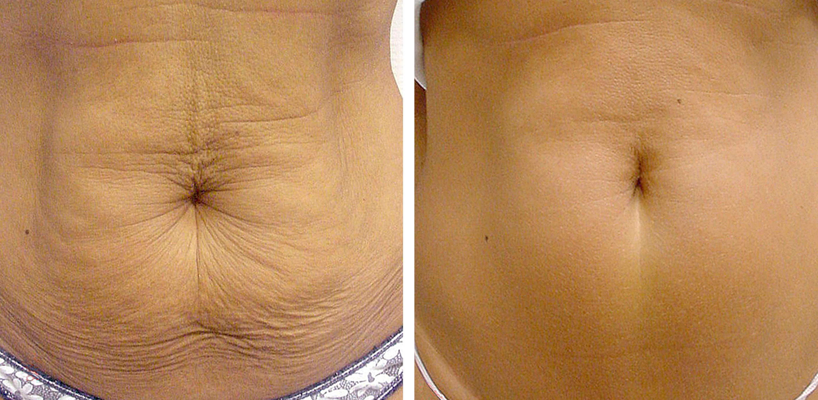 Thermage Tummy Before and After