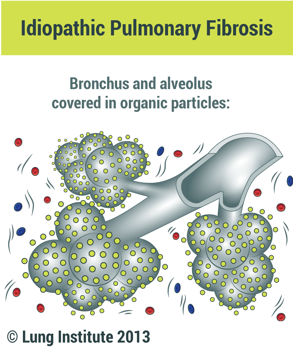 Lung Institute Supports Pulmonary Fibrosis Awareness Day with Unique ...