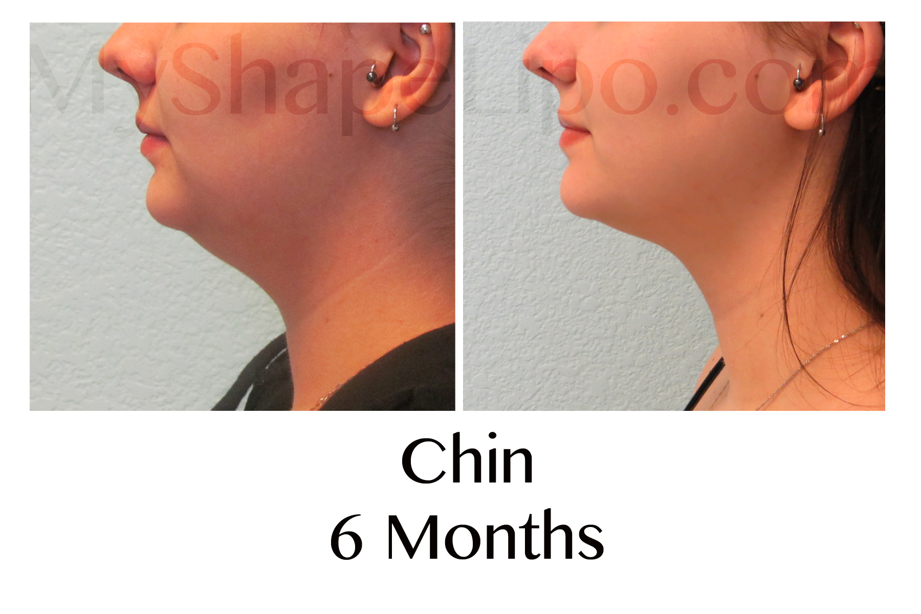 Chin Liposuction