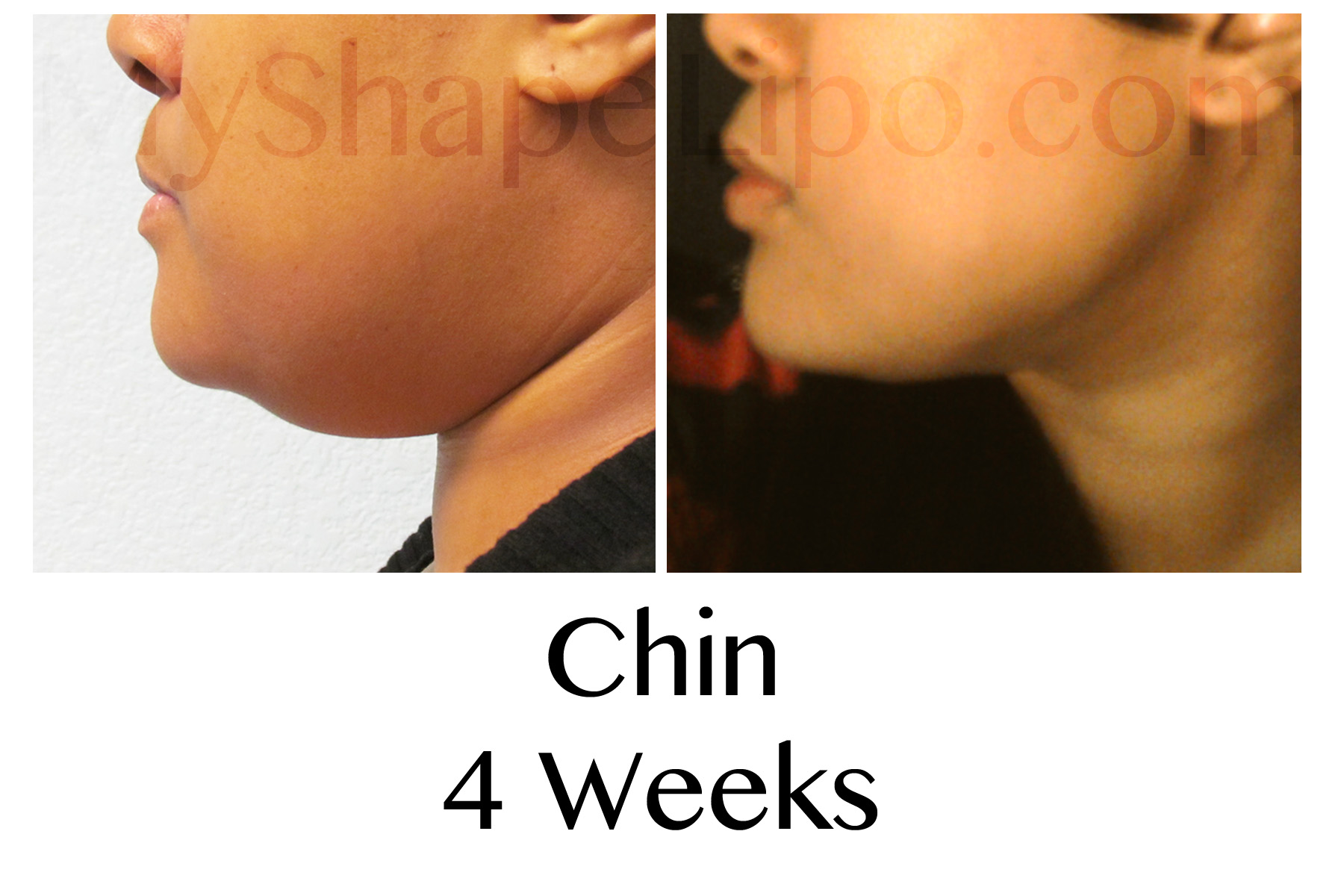 Change your profile with Chin Liposuction