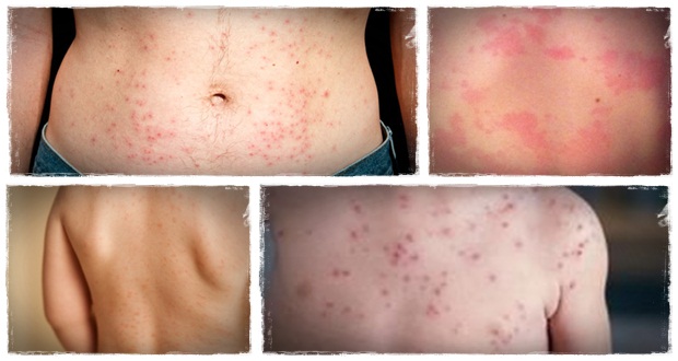 uses treatment skin Fast Urticaria How of Get â€œNatural Hives   Rid