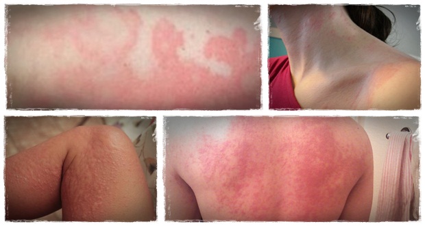 natural urticaria and angioedema treatment