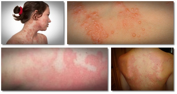 how-to-cure-hives-fast-how-natural-urticaria-relief-helps-people