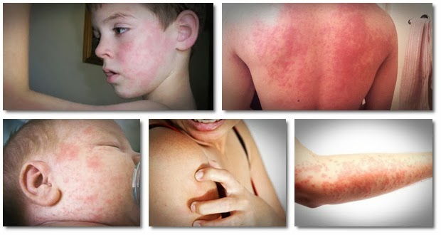 home remedies for urticaria
