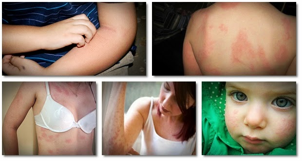 the urticaria solution