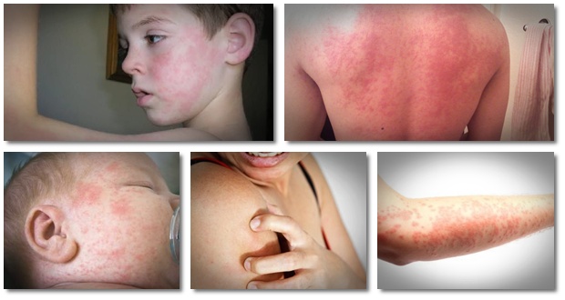 Chronic Hives Treatment How “get Rid Of Hives” Helps Sufferers Stop Hives Effectively Vinamy 2056