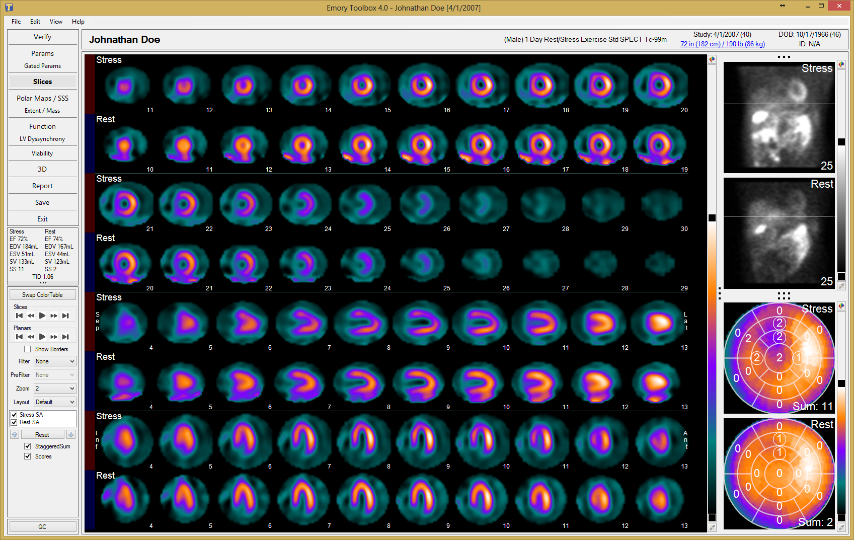 Syntermed's Emory Toolbox 4.0 decision support software shows a slices screen shot for a myocardial perfusion SPECT study.