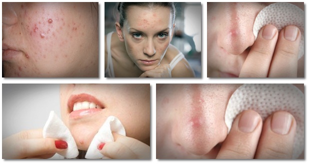 nodular acne treatment