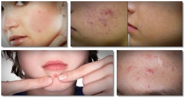 how to cure nodular acne