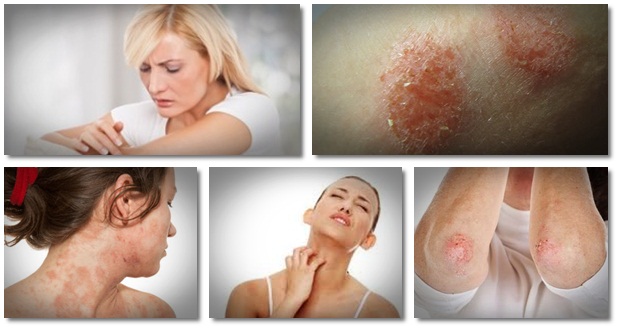 how to cure eczema naturally