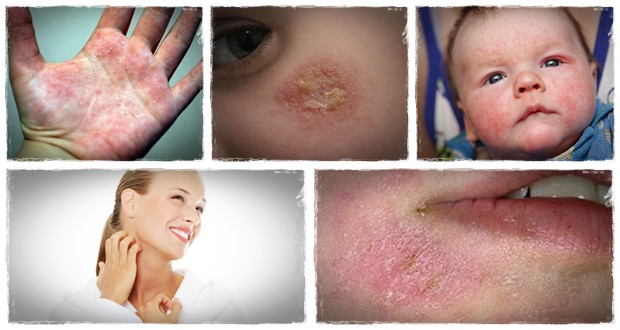 vanish eczema