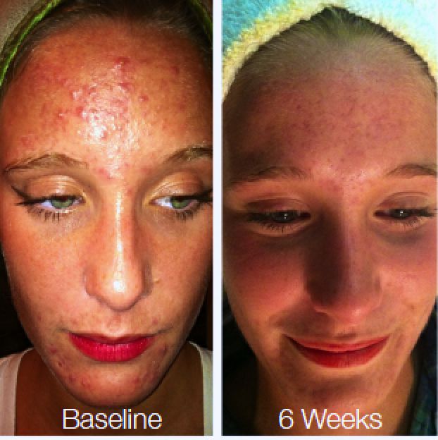 ClarityMD Acne Treatment